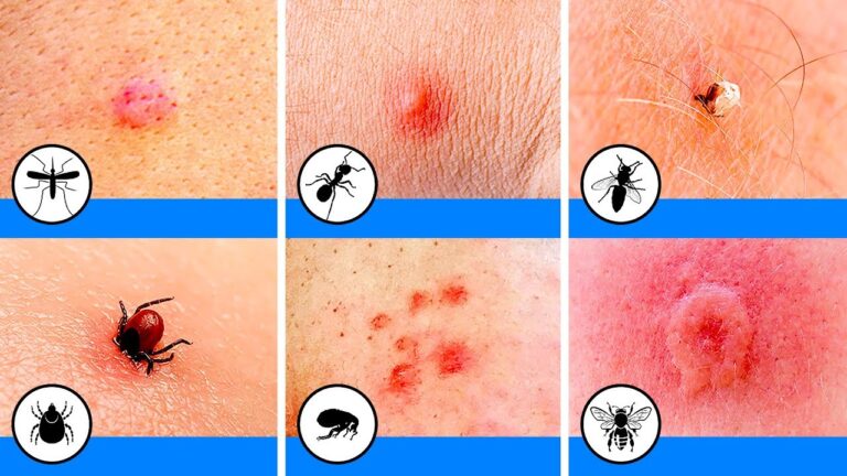 Alerta: Como lidar com a picada de pulga em bebês