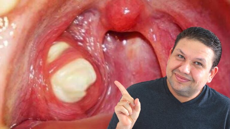 Desvendando a causa da coisa branca na garganta: dicas e tratamentos eficazes