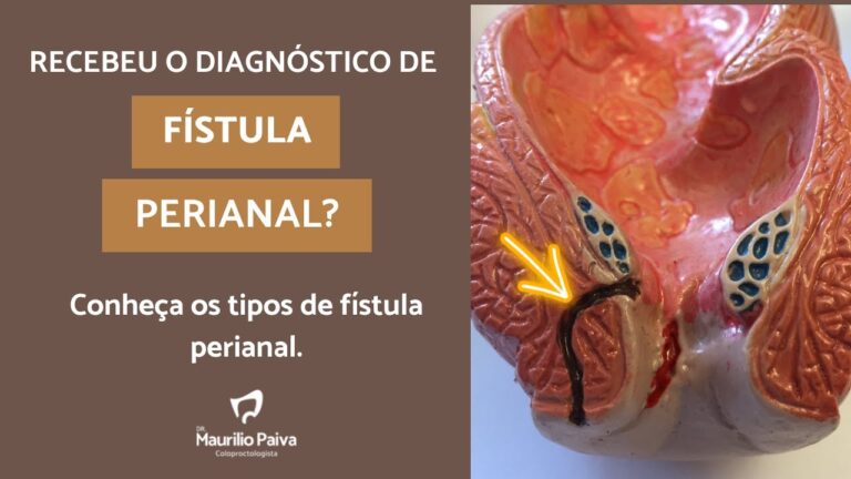 Descubra a eficácia da pomada para tratar e aliviar a fissura anal!