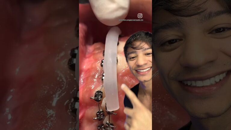 Viva a transforma&ccedil;&atilde;o: como lidar nos primeiros dias com aparelho dent&aacute;rio