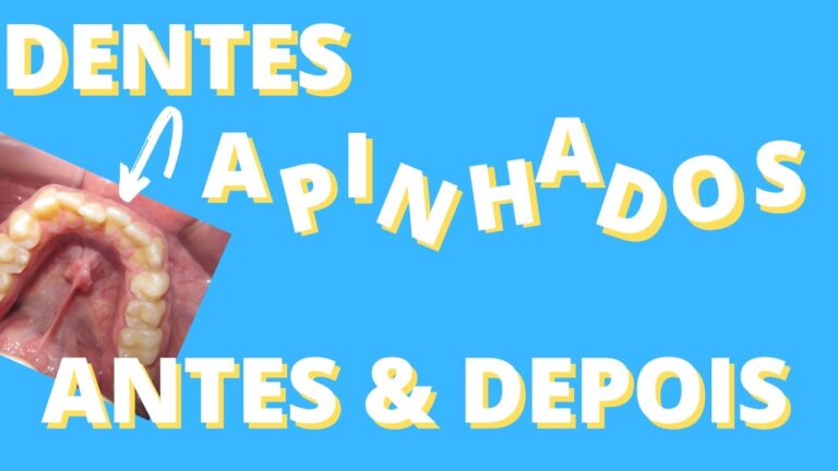 Transformação surpreendente: Aparelho Ortodôntico antes e depois de dentes encavalados!