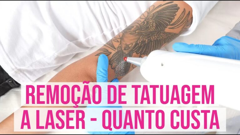 Tirar tatuagem a laser: descubra o preço acessível e eficaz em até 70 caracteres!