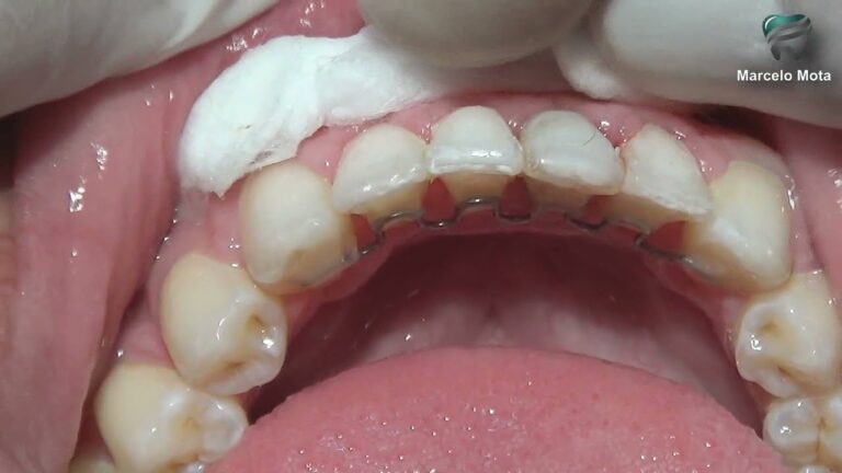 Aparelho de conten&ccedil;&atilde;o remov&iacute;vel: o segredo para um sorriso perfeito