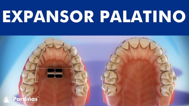 transforma-o-com-disjuntor-palatino-resultados-antes-e-depois