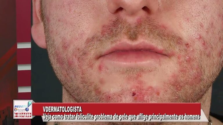 Barba impec&aacute;vel: Dicas infal&iacute;veis para evitar pelos encravados