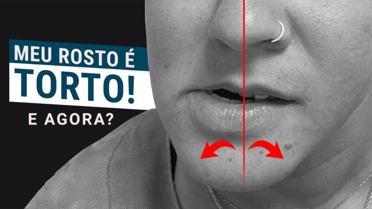 Maxilar torto: Dicas para corrigir e harmonizar seu sorriso