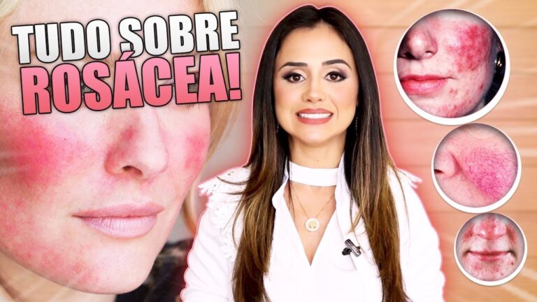 Rosácea: Descubra Remédios Caseiros Eficientes em 70 caracteres!