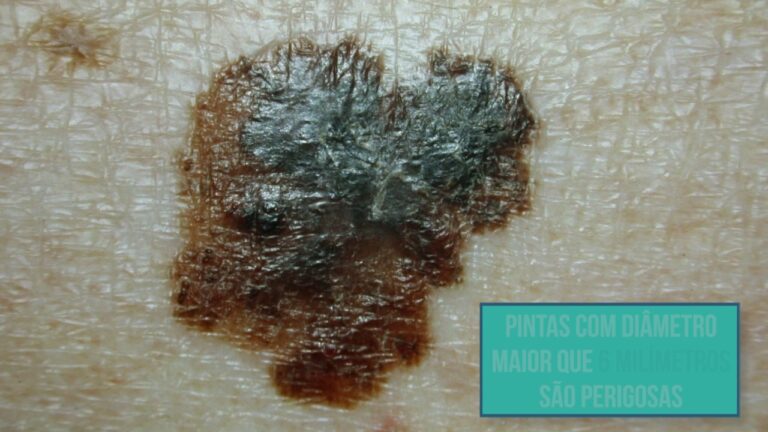 Verrugas Perigosas: Descubra os Tipos e Veja Fotos