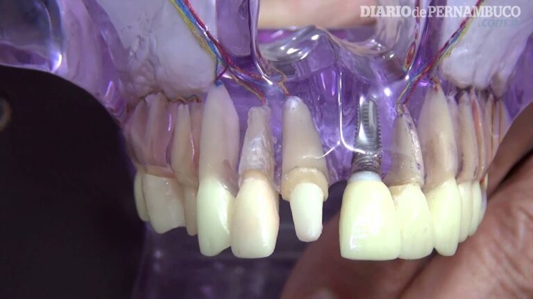 Piv&ocirc; dent&aacute;rio: tudo o que voc&ecirc; precisa saber!