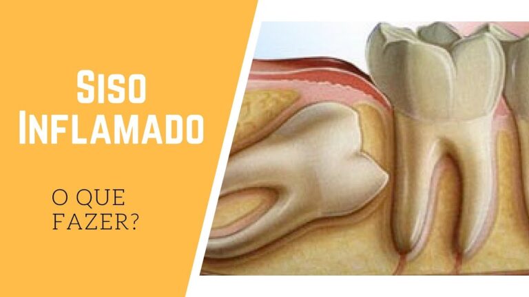 Sinais alarmantes de inflamação do siso: conheça os sintomas