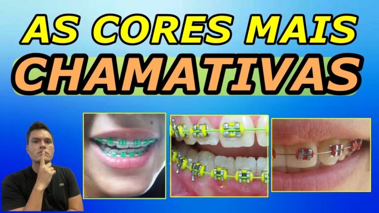 Aparelho: 10 Cores Bonitas para Escolher